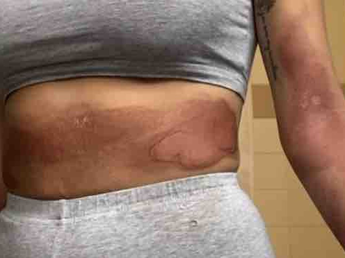 Fundraiser by Ashley Miyazaki : Burn Recovery
