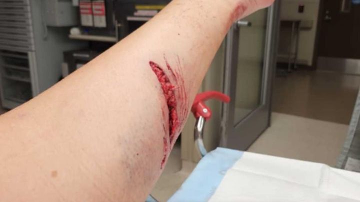 Severe dog attack campaign photo, 1 of 8