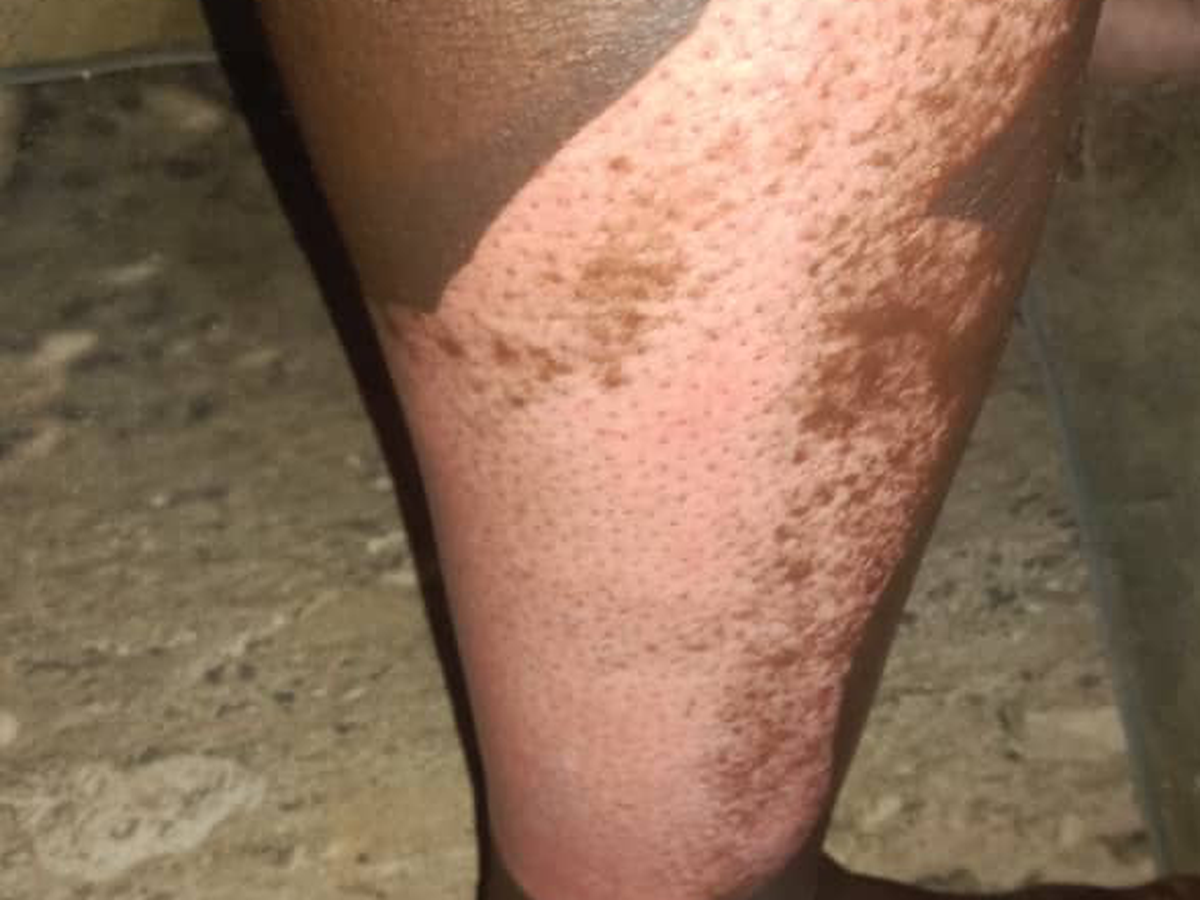 Fundraiser by Arndt Lange : Heavy skin bruises