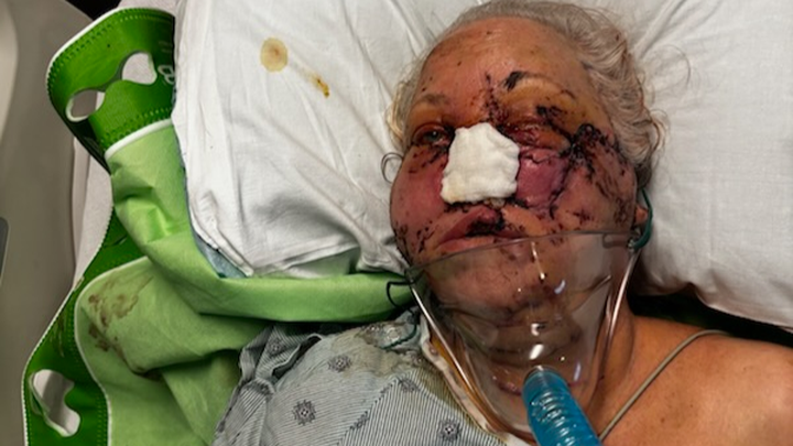 Sharon alvey's recovery from pitbull attack campaign photo, 1 of 4