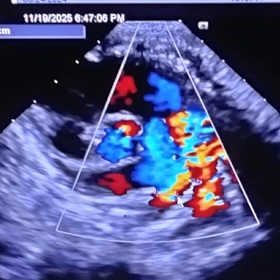 Heart surgery for my niece
