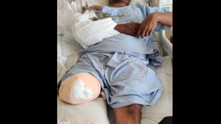 An Accident Took Rohan's Leg. Help Him Survive. campaign photo, 1 of 2