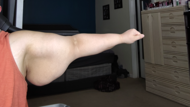 Megan's Life-Changing Lipedema Surgeries campaign photo, 1 of 3