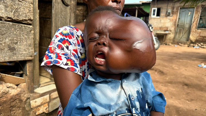 Help Save Meshack's Vision and Life campaign photo, 1 of 3
