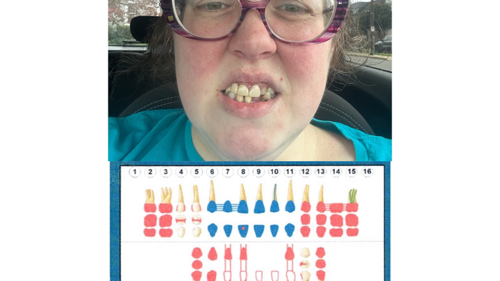 Donate to Preserve Remaining Teeth campaign photo, 1 of 6