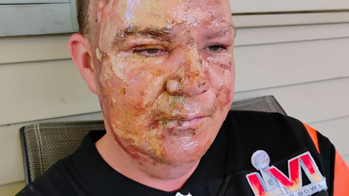 Support Jason's Recovery After Fire Accident campaign photo, 1 of 3