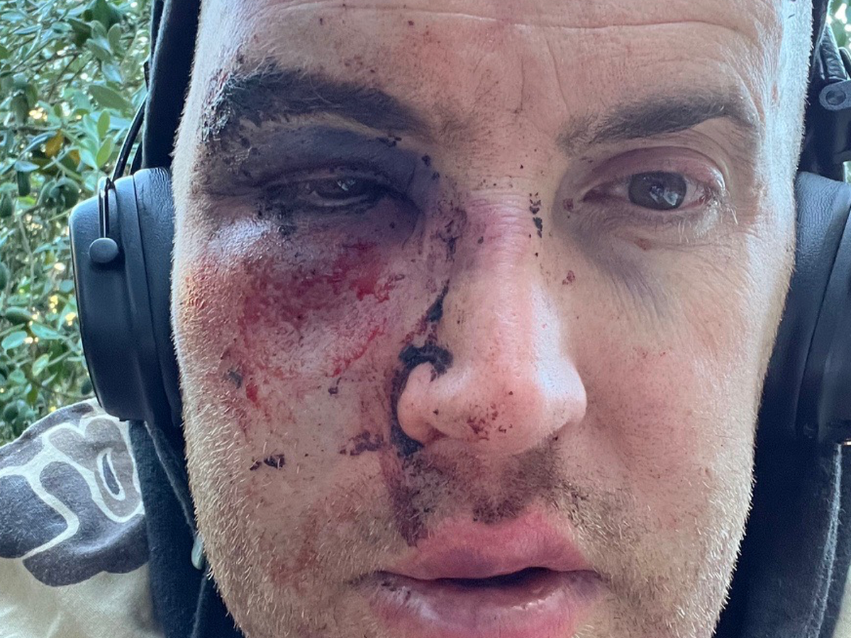 Fundraiser by Jake Luce : Support Jake's Recovery and Dental Care