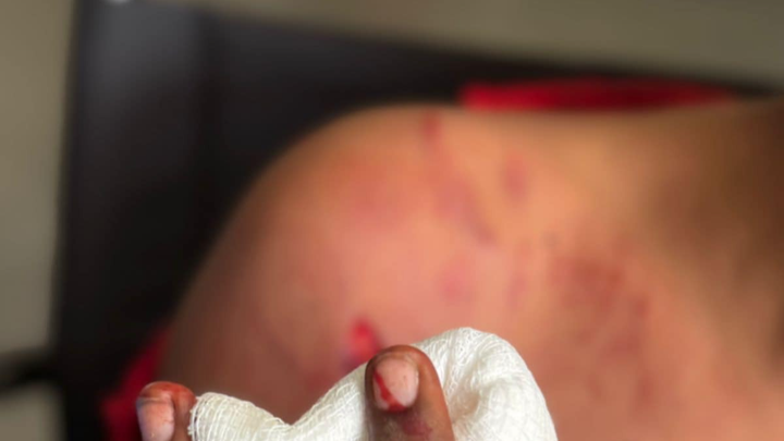 Help Ravin Recover from Rottweiler Attack campaign photo, 1 of 7