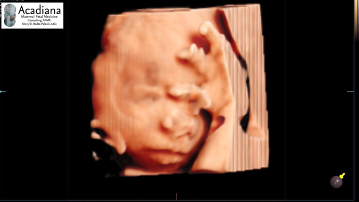 Single Pregnant Mama with TRAP Syndrome needs help. campaign photo, 1 of 6
