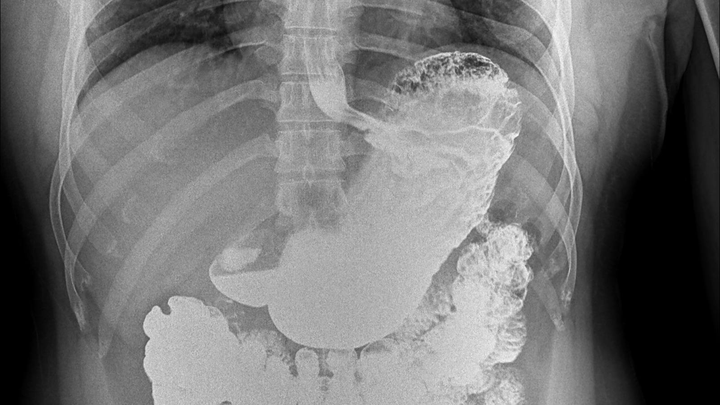 La operación de mi madre que tiene una Hiatal hernia campaign photo, 1 of 3