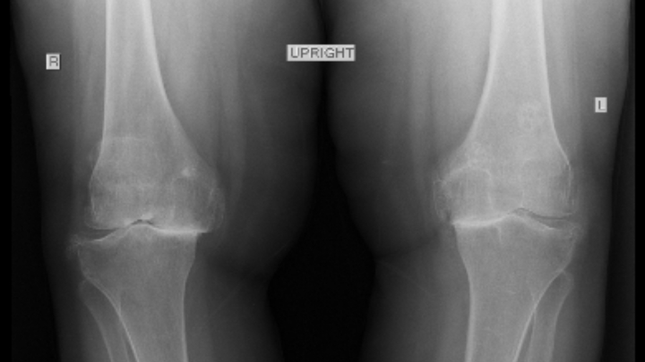 Help a Elderly Palestinian Woman Walk Again campaign photo, 1 of 3