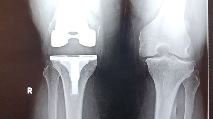 Aid My Recovery from Double Knee Replacement campaign photo, 1 of 5