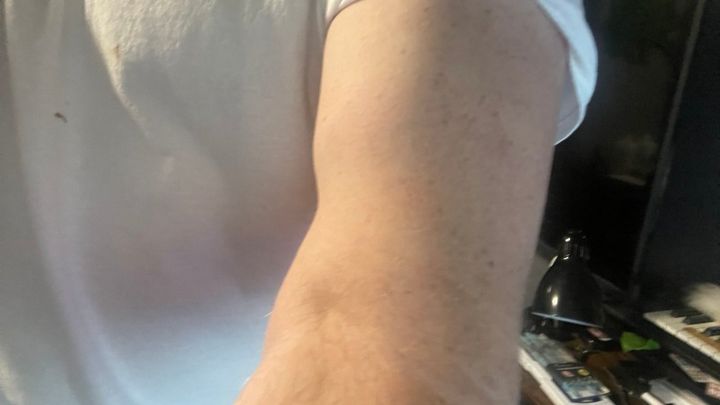 Arm Surgery Recovery Fund campaign photo, 1 of 6