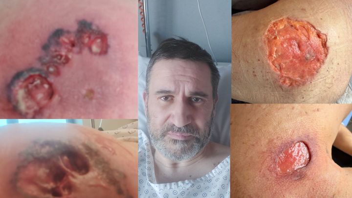 Photo de la campagne Ma vie après un Pyoderma Gangrenosum., 1 sur 3