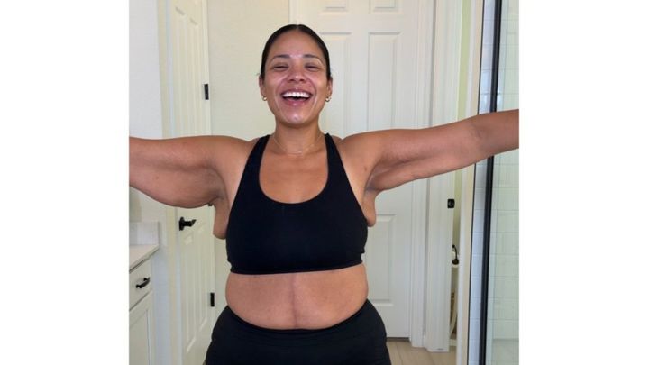 Ana Second Round of Excess Skin Removal - 250 lbs weightloss