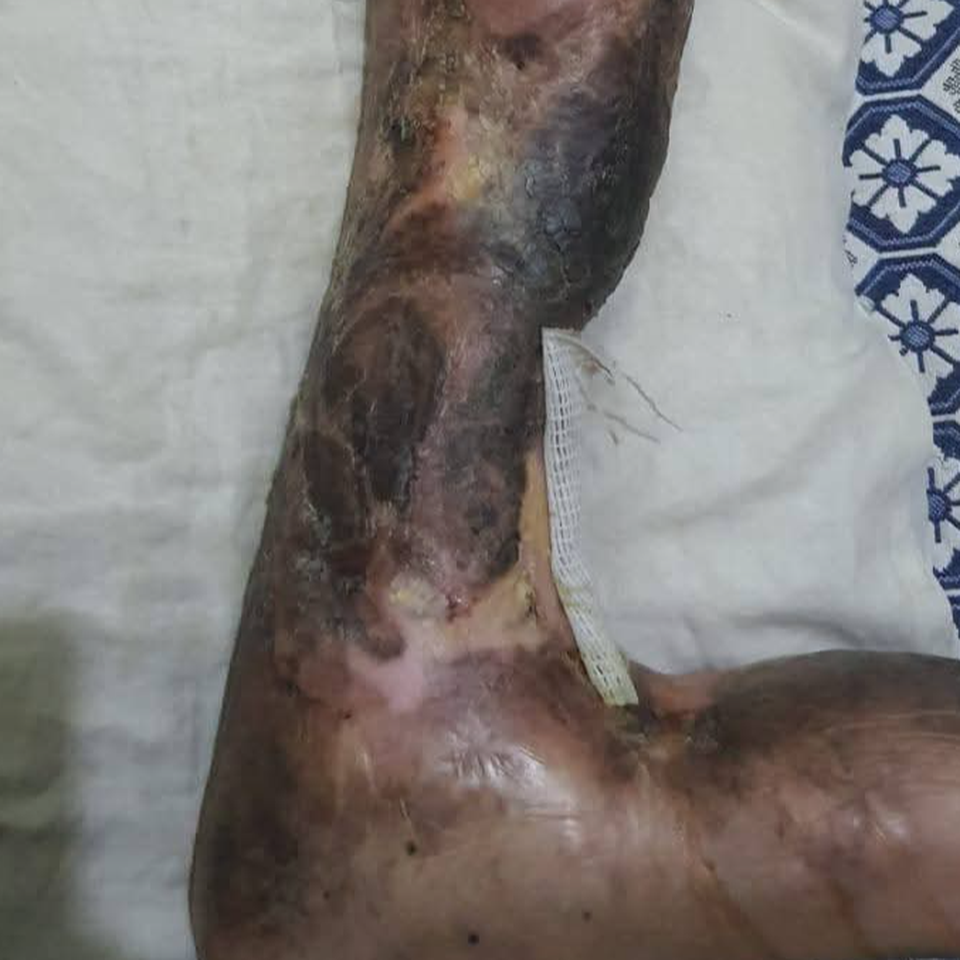 Urgent Medical Appeal: Alleviating Severe Suffering