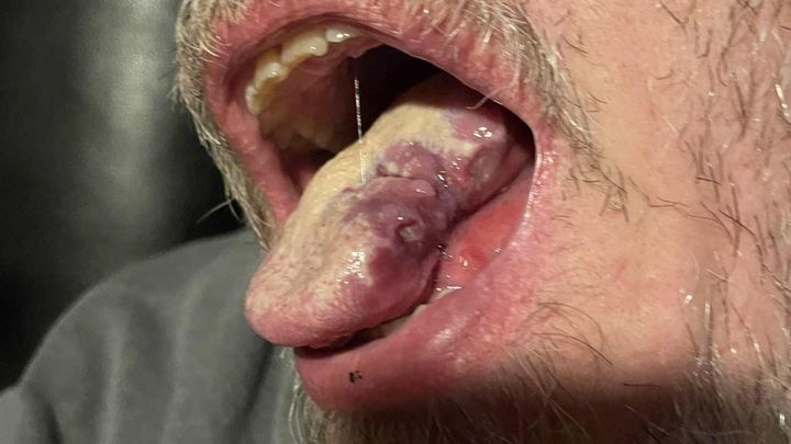 Help Guy Sharp BEAT oral Cancer! CANCER SUCKS! campaign photo, 1 of 8