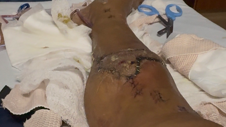 Support Recovery After Devastating Accident campaign photo, 1 of 4