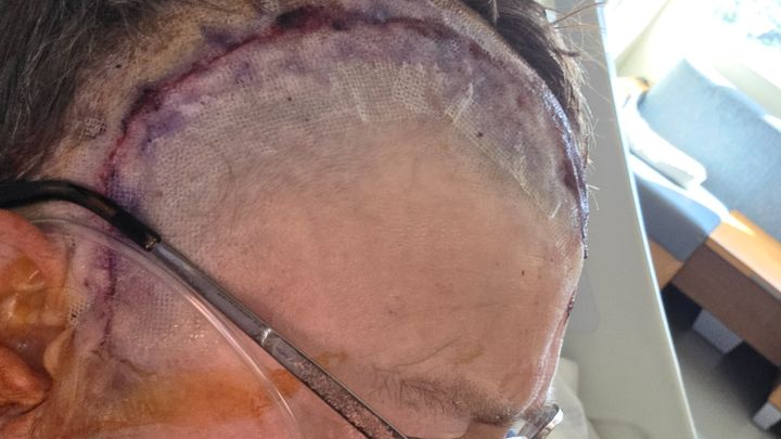 Help With Recovery After Tumor and Lung Surgery campaign photo, 1 of 5