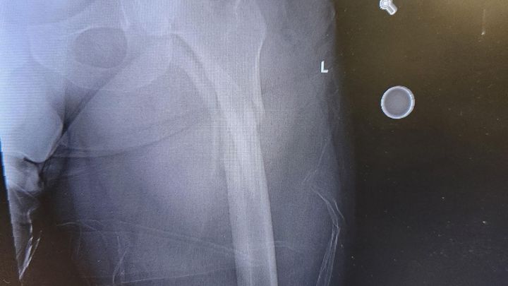 Support My Husband’s Surgery Costs After a Serious accident
