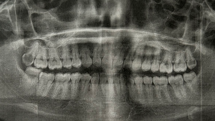 Help Tiffani Get Urgent Wisdom Teeth Surgery campaign photo, 1 of 2