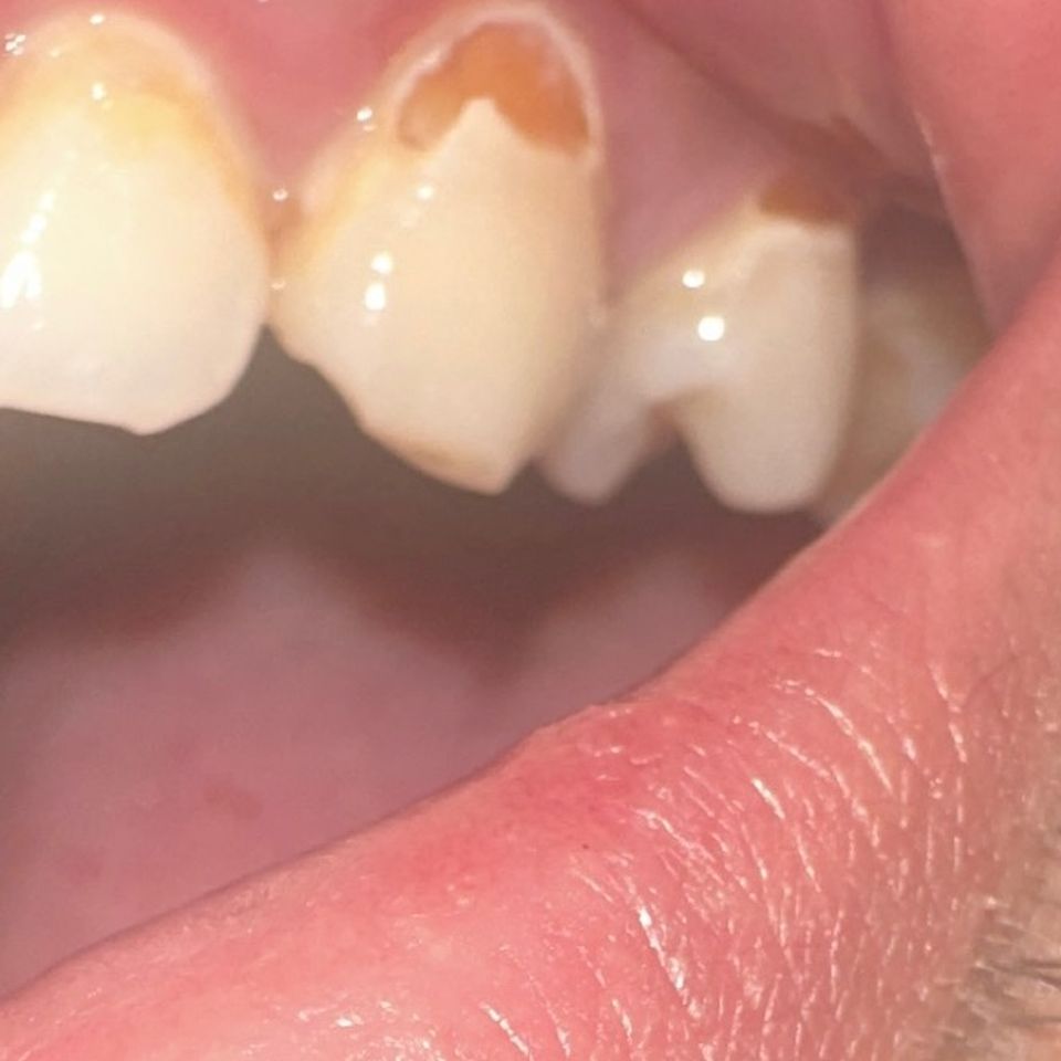Estoy sufriendo por un diente dañado y necesito ayuda urgent