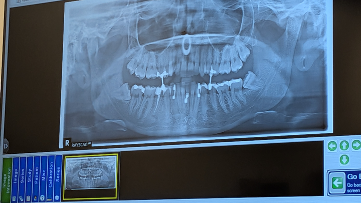 Help Violet Afford Wisdom Teeth Surgery campaign photo, 1 of 4