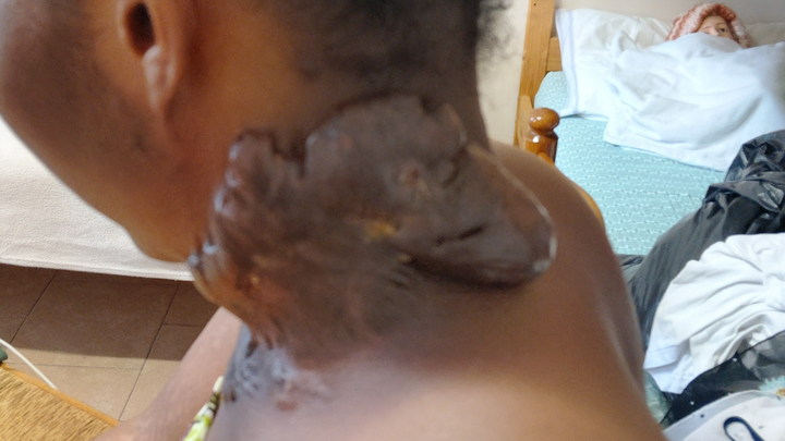 Give Anastasia hope: urgent keloid surgery needed campaign photo, 1 of 8