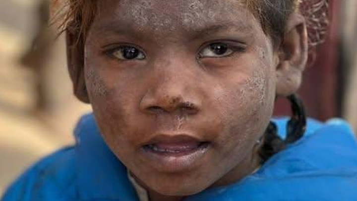 Akash Burned his Hand Very Badl He needs Immediate H campaign photo, 1 of 8