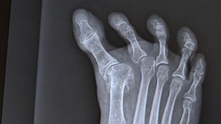 Help Ursula Recover From Foot Surgery campaign photo, 1 of 8