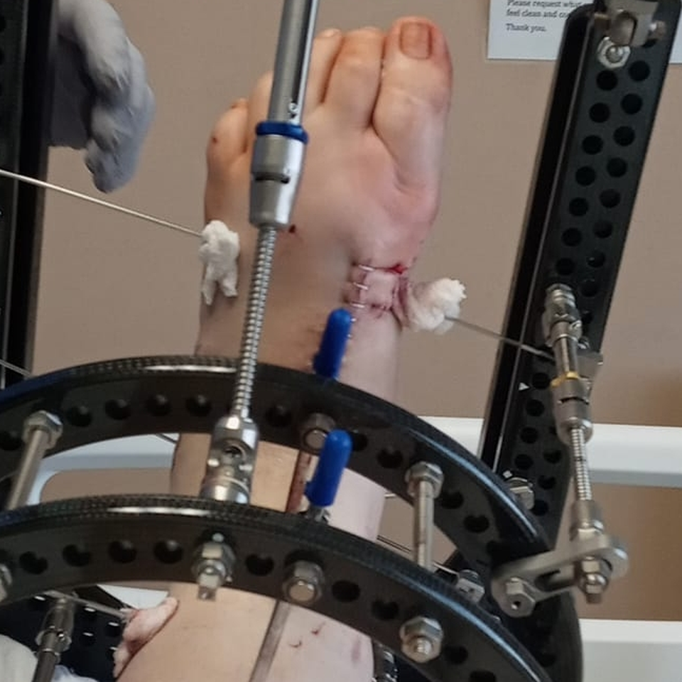 Help Support Shelbie While Recovering From Amputation