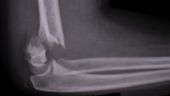 Broken Arm campaign photo, 1 of 4