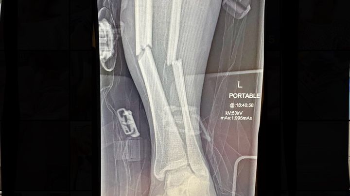 Get Holly back on her feet campaign photo, 1 of 4