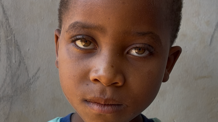 Down-syndrom Kids in Malawi campaign photo, 1 of 5