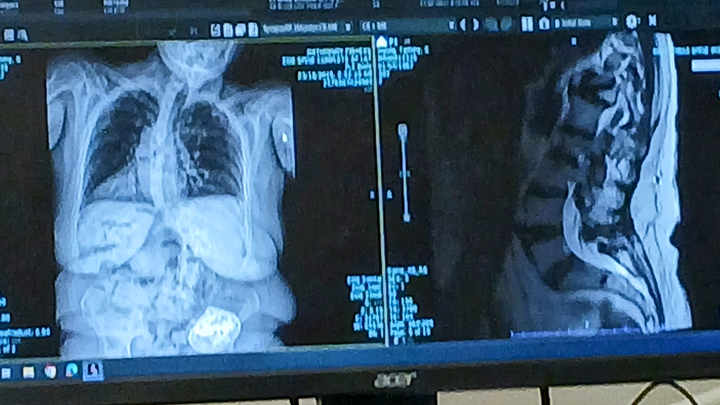 Support Tammy's Surgery, I have crippling scoliosis & steop campaign photo, 1 of 7