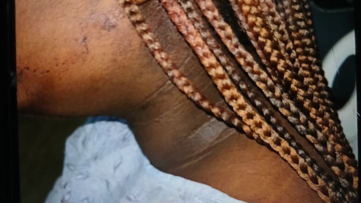 Keira Harps Needs Care After Being Struck in the Head campaign photo, 1 of 3