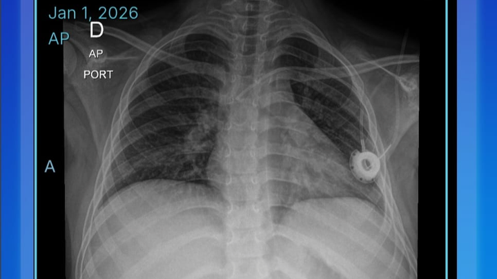 Transplante de medula osea leucemia (LLA) campaign photo, 1 of 7