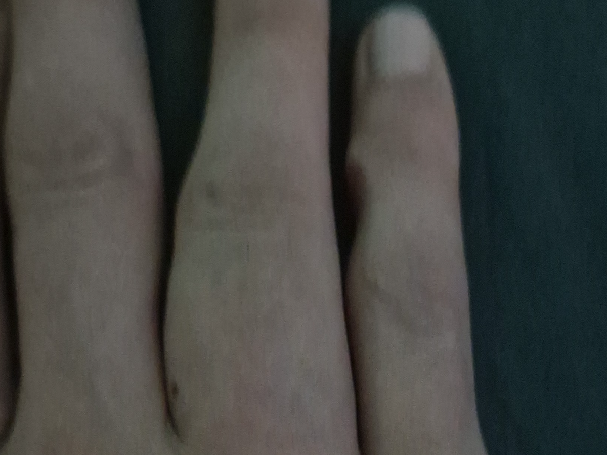 Hola! Tengo un tumor en los huesos de mi mano campaign photo, 1 of 8
