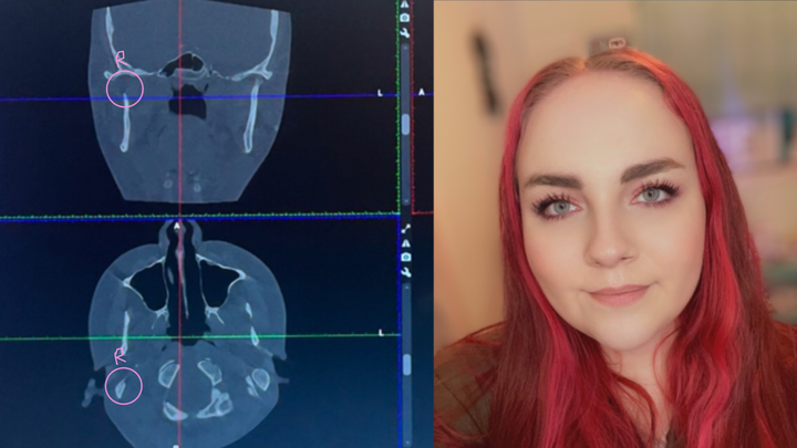 Urgent Help Needed for Jayde’s EDS Jaw Surgery campaign photo, 1 of 3