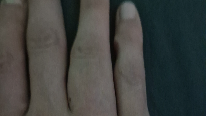 Hola! Tengo un tumor en los huesos de mi mano campaign photo, 1 of 8