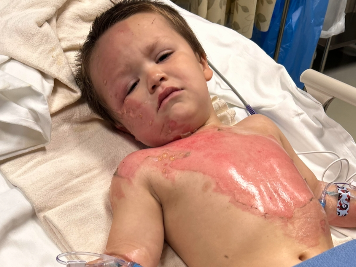 Lyle Roger's Burn Recovery campaign photo, 1 of 6