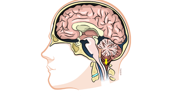 Help Me Through My Third Chiari Decompression Surgery campaign photo, 1 of 6