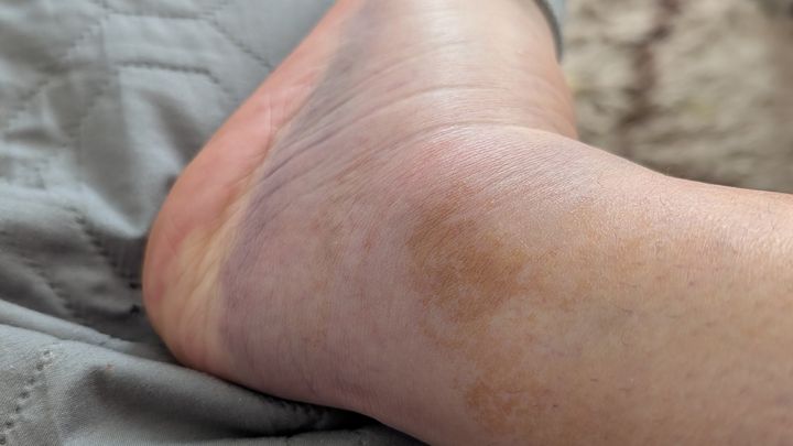 Kathy's Journey to Walk Again After Coma campaign photo, 1 of 8