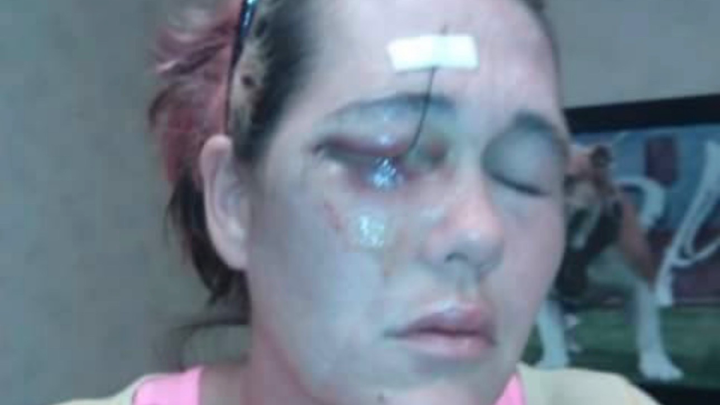 Help Bryon's Fiancée Fight Life-Threatening Infection campaign photo, 1 of 3