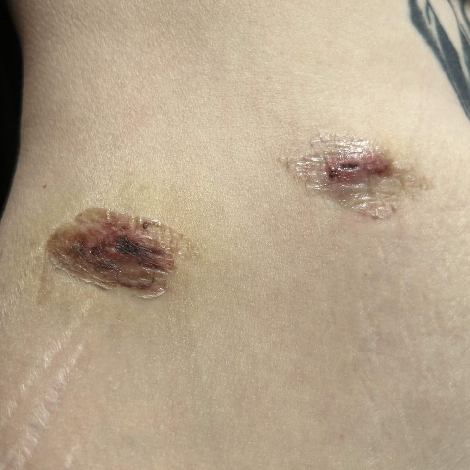 fresh cigarette burn Clinical Forensic Medicine A wA cigarette burn on