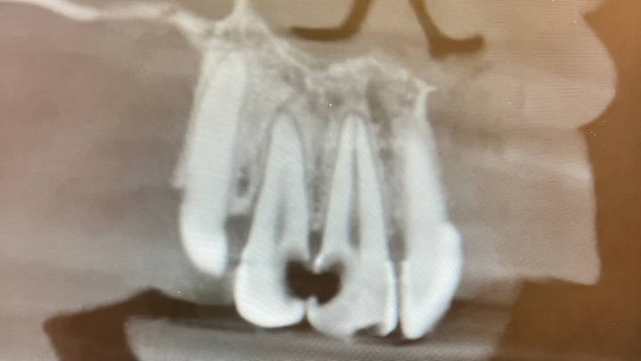Help Ms. Bambii Smile Again — Urgent Dental Restoration Fund campaign photo, 1 of 8