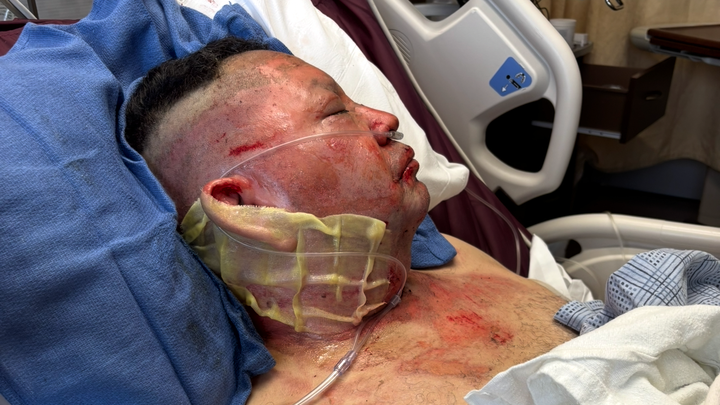 Support Gerardo Esparza's Burn Recovery campaign photo, 1 of 3