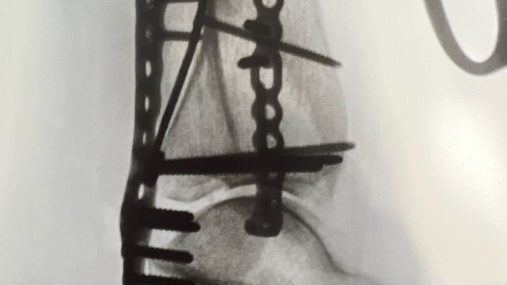 Kelene Needs Your Help for Her Ankle Recovery campaign photo, 1 of 5