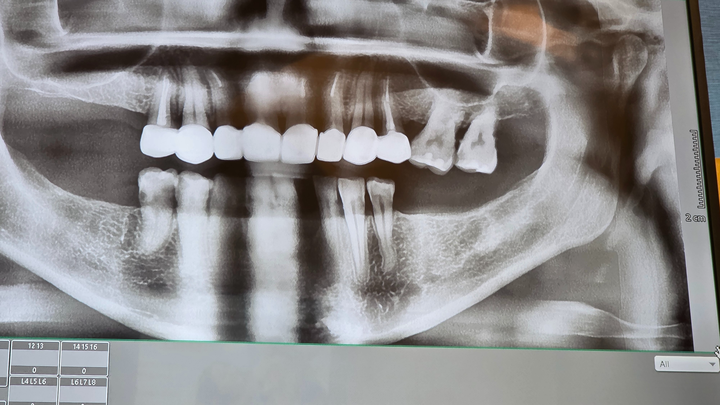 Help Me Smile & Eat Again – Urgent Dental Surgery Needed campaign photo, 1 of 6